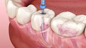 Root Canal Treatment (RCT)